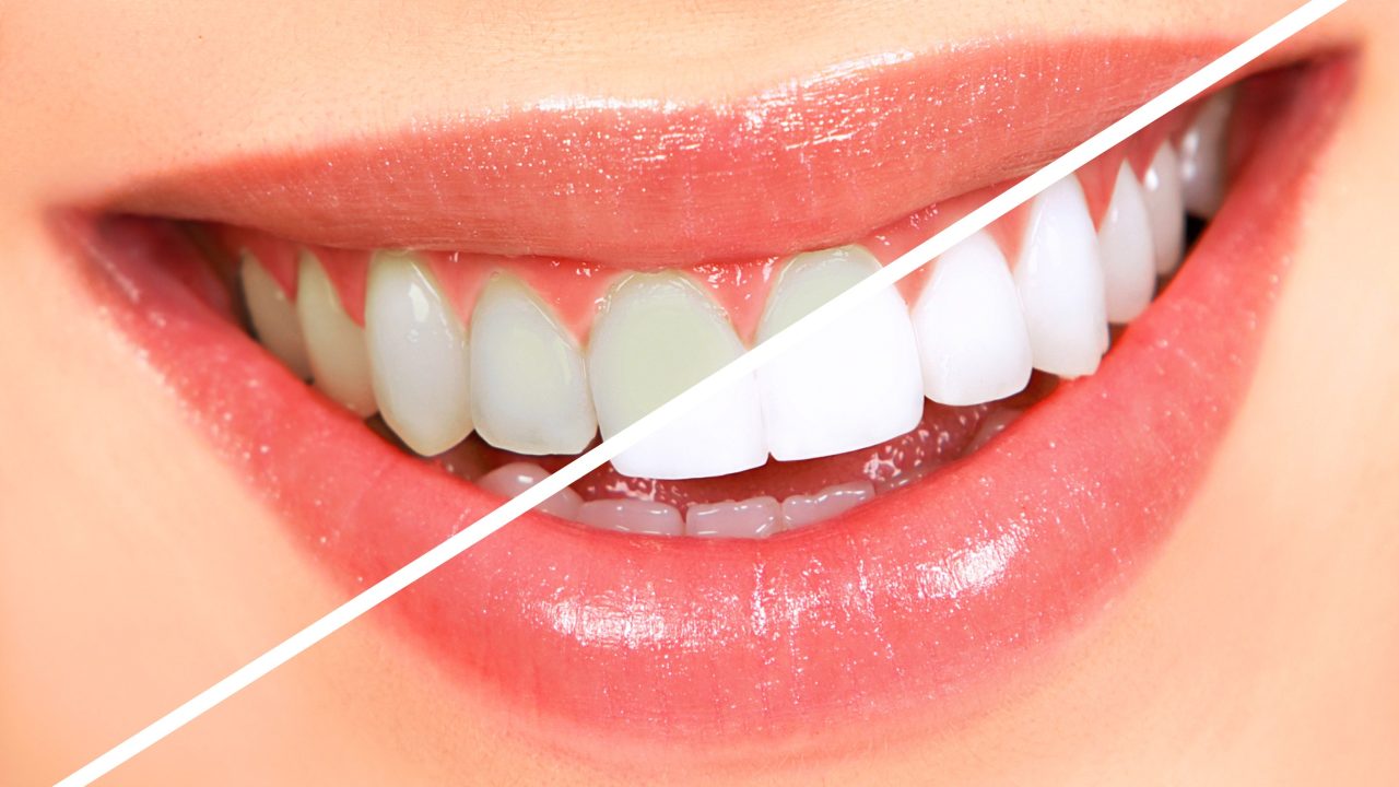 The Unexpected Connection Between Teeth Whitening and Oral Health