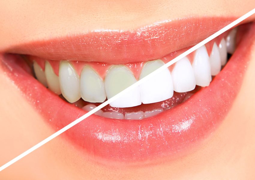 The Unexpected Connection Between Teeth Whitening and Oral Health