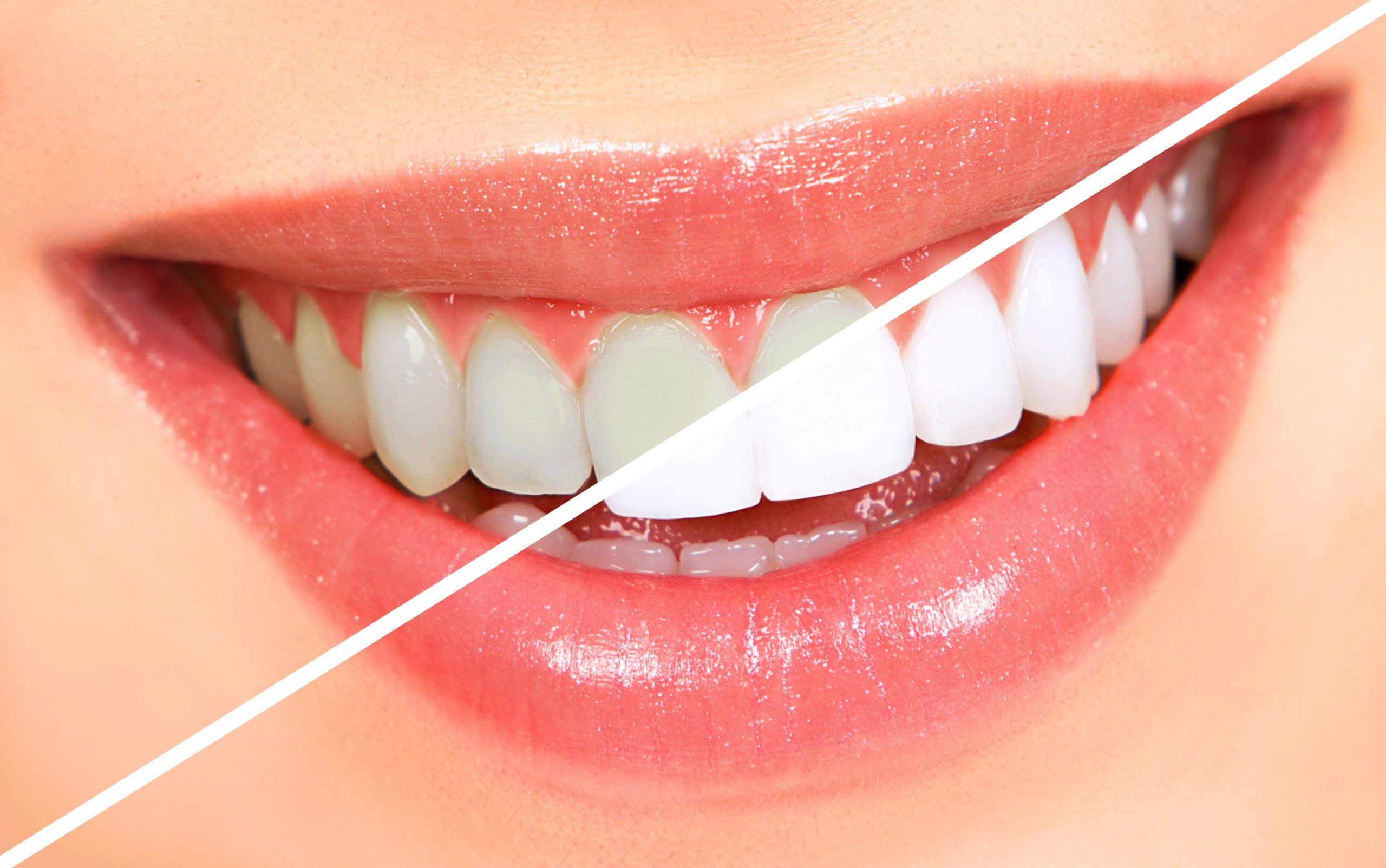The Unexpected Connection Between Teeth Whitening and Oral Health